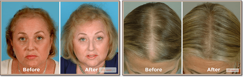 RedRestore MAX Laser Hair Growth 272 Diode  Lowlevel Laser Therapy
